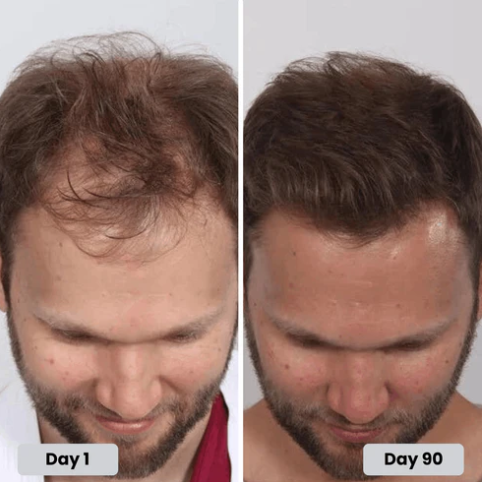 Red Light Therapy Hair Growth Hat