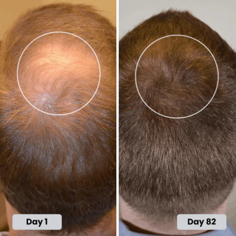 Red Light Therapy Hair Growth Hat