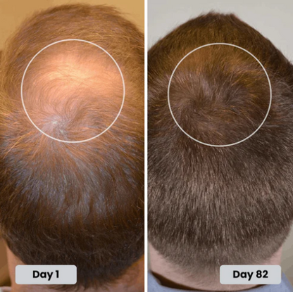 Red Light Therapy Hair Growth Hat
