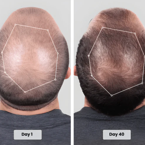 Red Light Therapy Hair Growth Hat