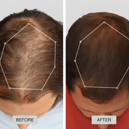 Red Light Therapy Hair Growth Hat