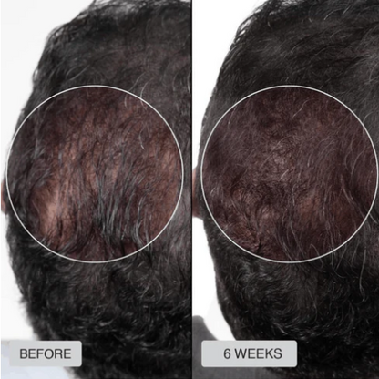 Red Light Therapy Hair Growth Hat